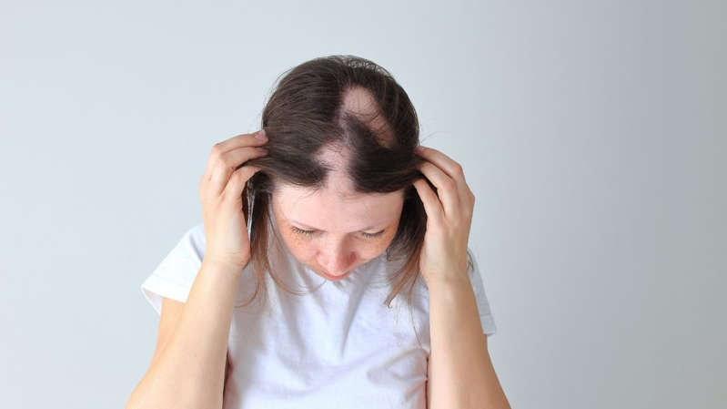 ALOPECIA - O Esportivo